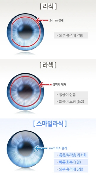 시력교정수술(라식,라섹등) 과정 사진